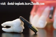 Affordable Dental Tooth Implants