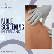 Where to Go for Mole Screening in Ireland?