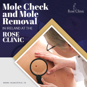 Mole Check and Mole Removal in Ireland at the Rose Clinic,  Cork